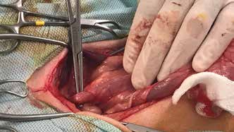           /CLINICAL EXPERIENCE OF ARTIFITIAL URETHRAL SPHINCTER IMPLANTATION FOR REFRACTORY URINARY INCONTINENCE TREATMENT