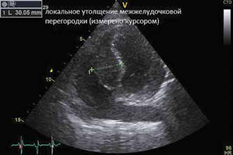          --  / Clinical case of primary interventricular septum hemangiosarcoma with concurrent WPW syndrome