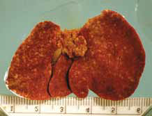 Печень котенка, врожденно инфицирован- ного Toxoplasma gondii. Многочисленные бело-желтые области обесцвечивания вызваны некрозом, произведенным тахизо- итами [17]