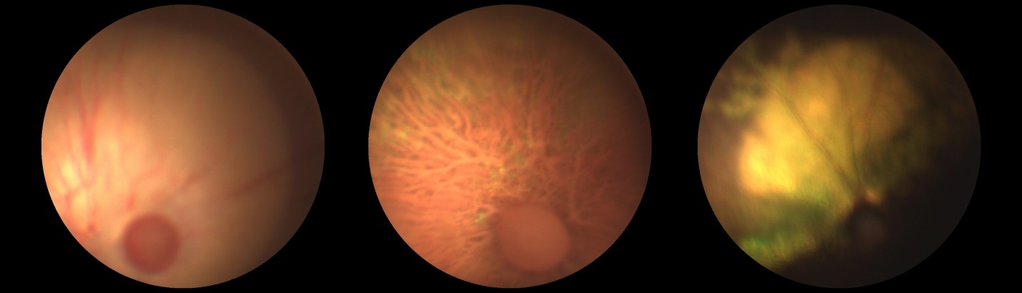 Рисунок 11. Офтальмоскопическая картина сетчатки и ДЗН собак при терминальной стадии глаукоматозного процесса. Глаукоматозная экскавация ДЗН, гиперрефлексия тапетума, исчезновение сосудов сетчатки