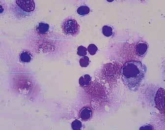 Клетки лимфомы в асцитической жидкости, азур-эозин, ×1000