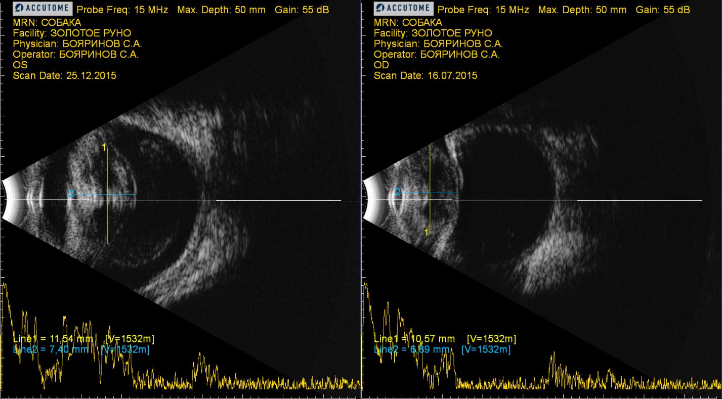 Рисунок 12. Ультрасонографическая картина глазного яблока при вторичной факогенной глаукоме. Факоморфическая глаукома (слева), факотопическая глаукома в результате люксации хрусталика в ПК (справа).