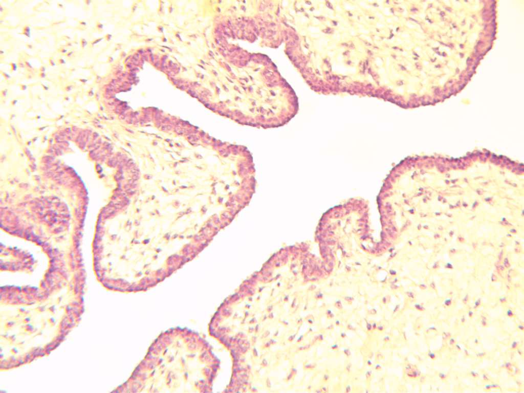 Фиброаденома молочной железы. Эпителиальные опухолевые клет- ки формируют сосочковые и папиллярные структуры. Междолько- вая соединительная ткань в состоянии фиброза, занимает большой объем ткани. Соотношение эпителиального и миоэпителиального компонентов