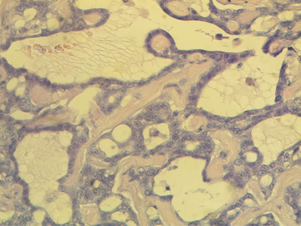 Папиллярный рак молочной железы комплексного типа. Клетки опухоли формируют сосочковые структуры, в центре которых определяется соединительнотканная ножка. Окраска гематоксилином и эозином. Увеличение: окуляр х10, объектив х40