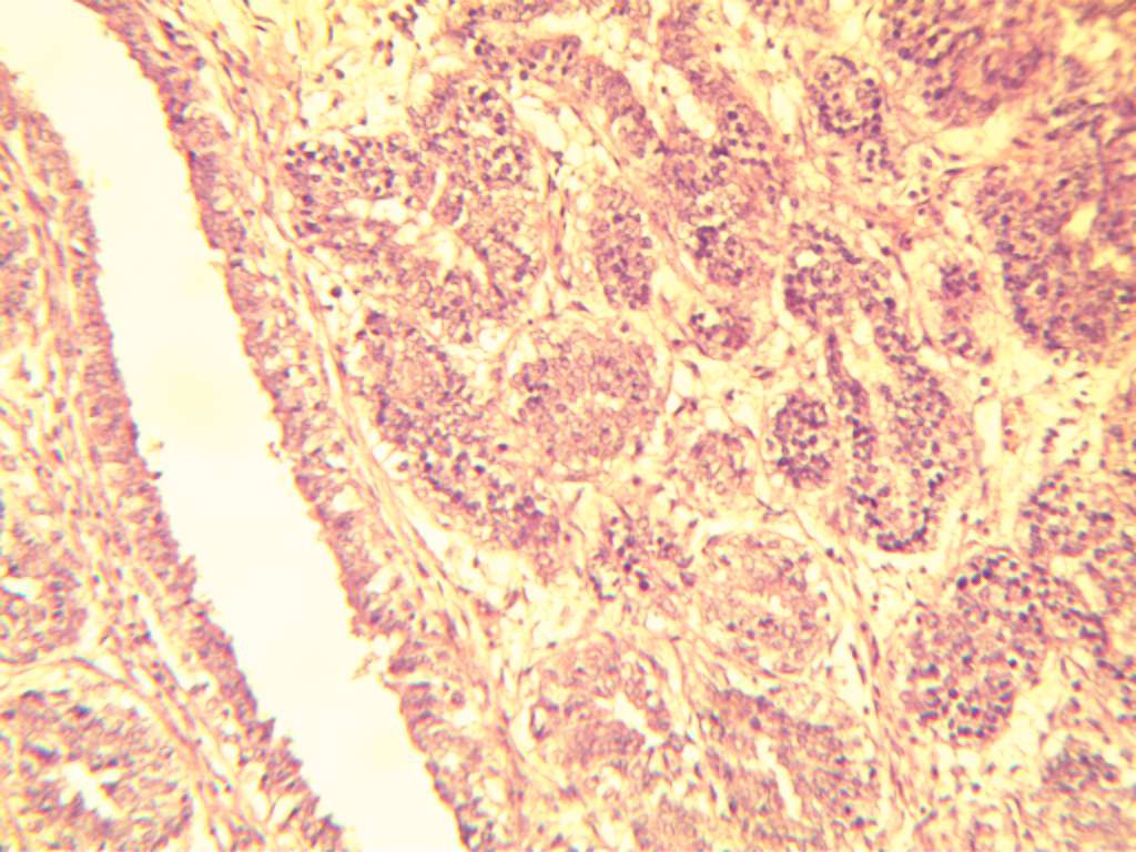 Рис. 3. Фиброаденоз молочной железы. В полях соединительнотканной стромы с признаками фиброза выявляются гиперплазированные протоки железы. Окраска гематоксилином и эозином, увеличение: окуляр х10, объектив х40.