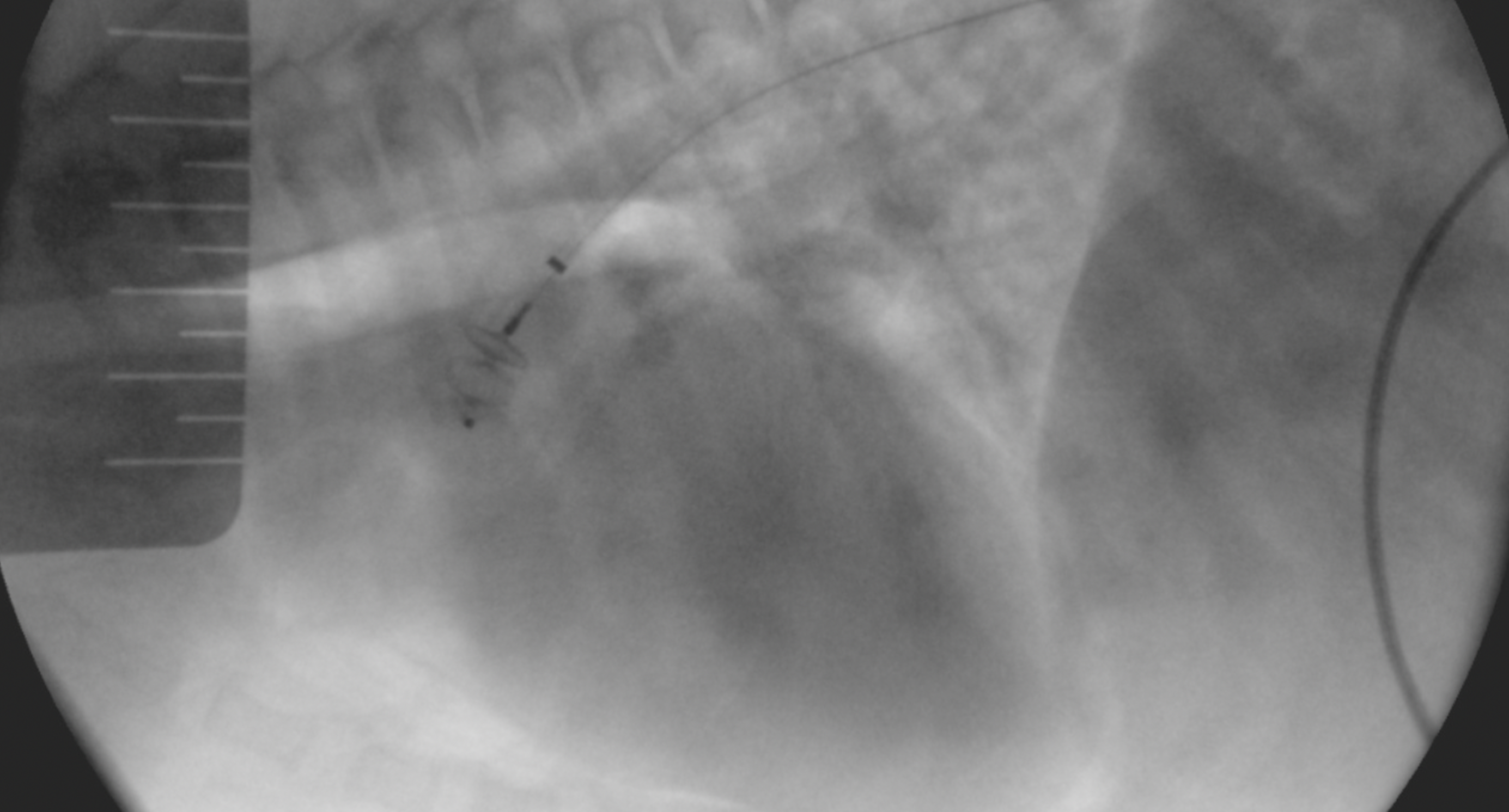 Рентгеноскопический снимок. Средний и третий диск расположены в ампуле ОАП