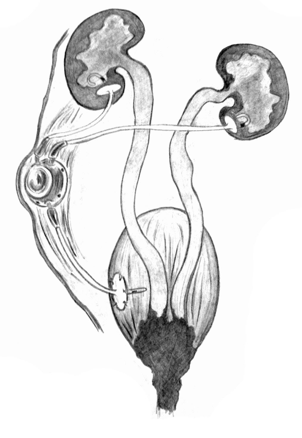 Схематическое изображение субкутанного нефровезикулярного шунтирования (рисунок доктора Марии Назаровой)