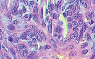 Гистологическая картина умереренно-дифференцированного рака молочной железы комплексного типа. Увеличение *4, *10, *40,*100. Окраска гемотоксилин-эозин