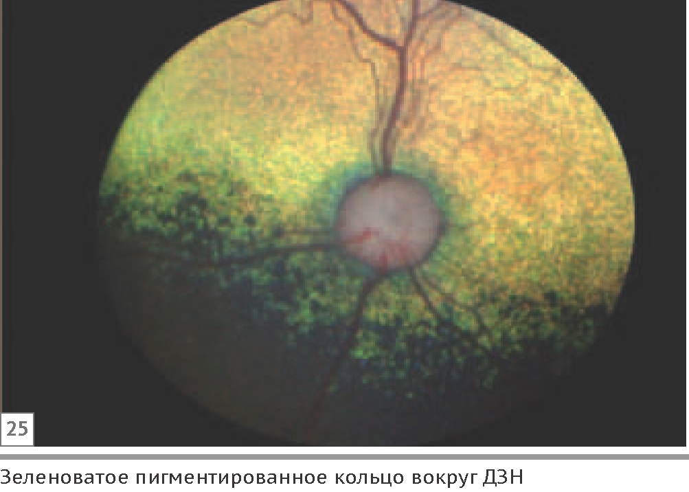 Гифема глаза у кота лечение