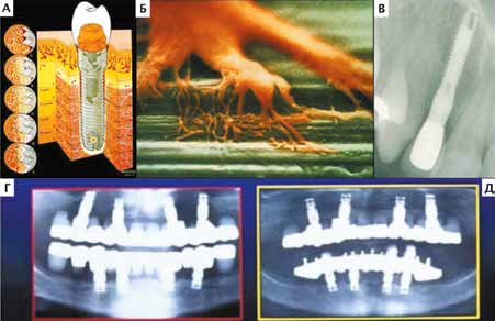 Принцип остеоинтеграции (схематично). А, Б – прочная структурная связь титана с костной тканью; В – рентген установленного дентального (остеоинтегрируемого) протеза: Г, Д – рентген одних из первых имплантируемых дентальных имплантатов в 1969 г. (Г) и чере