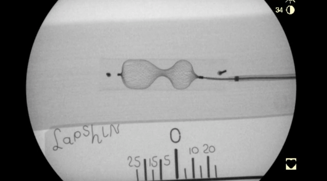 Рисунок 1: Рентенограмма одного из типов сосудистого окклюдера Амплацера