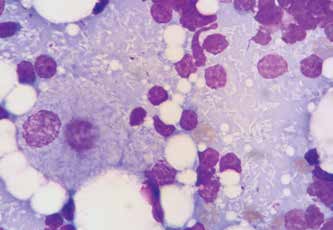 Материал из лимфатического узла, окраска по Романовскому: макрофаг, несколько малых лимфоцитов, разрушенные клетки и значительное количество негативно окрашенных палочковидных бактерий. Окраска по Цилю-Нильсену [рис. 2.]