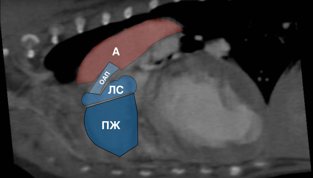 Рисунок 3а КТ-ангиография с пояснениями. Двухмерное изображения ОАП. А – аорта, ОАП – открытый артериальный проток, ЛС – лёгочный ствол, ПЖ- правый желудочек.