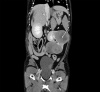 Отчет о клиническом случае: Тяжелая, рефрактерная гипогликемия у 9-летнего бретонского эспаньола с нефробластомой почки