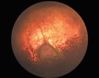 Рис.5 Офтальмоскопия при прогрессирующей атрофии сетчатки