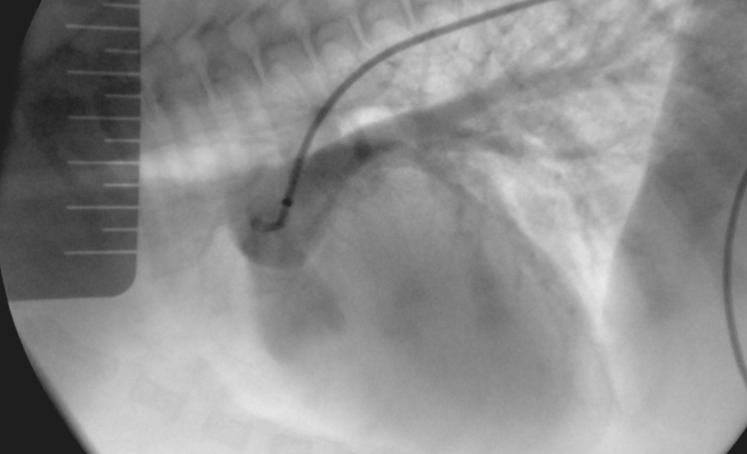 Рентгеноскопический снимок. Контрастирование из ампулы ОАП. Визуализируется остриум. Также окрашена легочная артерия