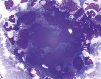 Метастаз рака железистого строения (рак легкого), плевральная жидкость, азур-эозин, ×1000