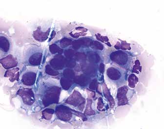 Метастаз рака железистого строения (рак молочной железы), асцитическая жидкость, азур-эозин, ×1000