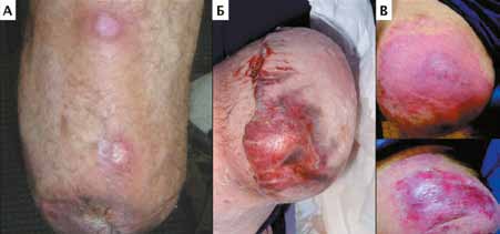 Осложнения после использования протезов с культеприемной гильзой (КП-протезы) опрелости (А), некроз кожи (Б), контактный дерматит (В)