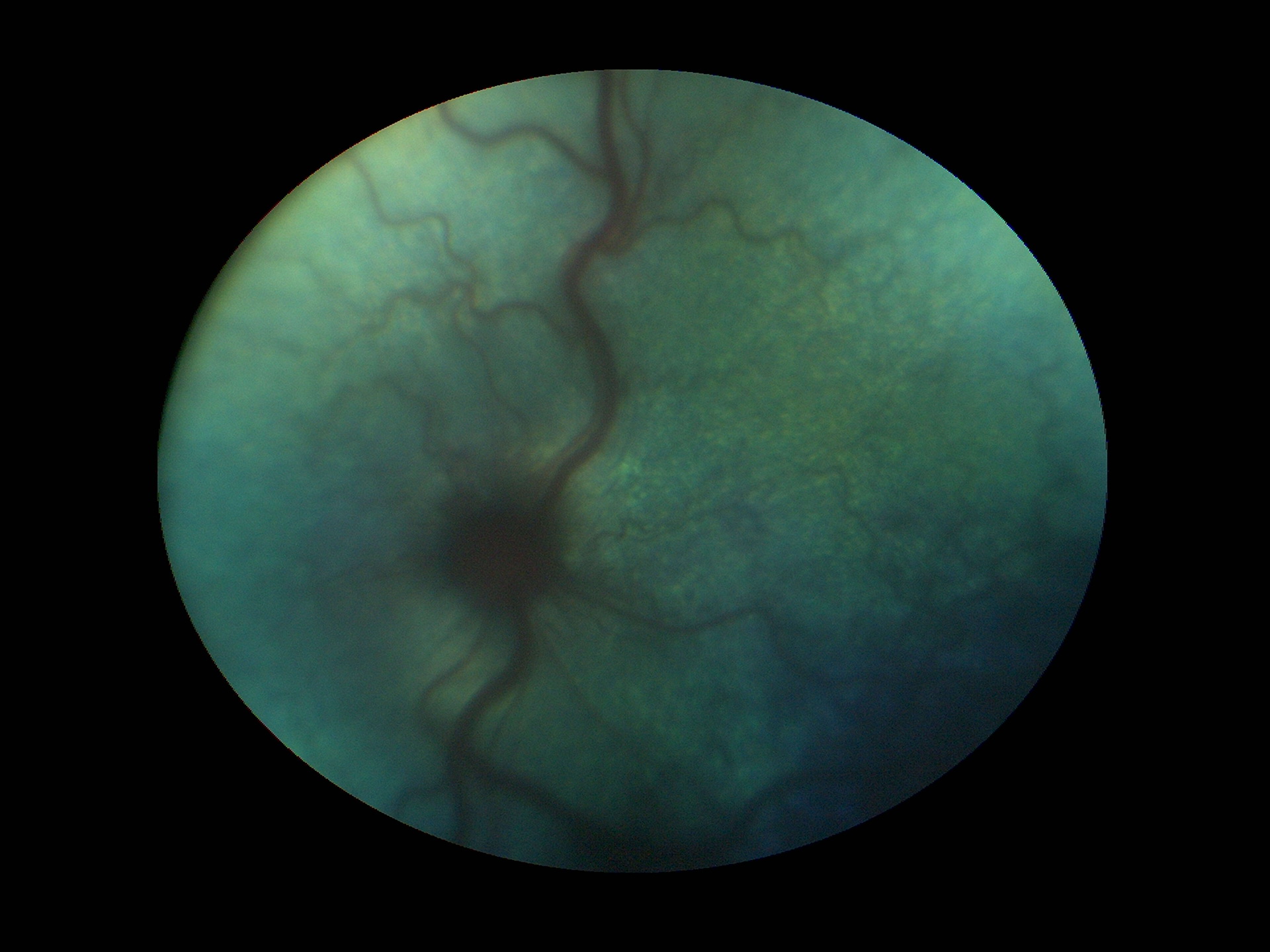 Рис.17 Передний увеит,увеальная глаукома,хориоретинит,гипервискозный синдром и неврит ДЗН у кота с FeLV ,FIP(глазное дно на левом глазу изначально не просматривалось).