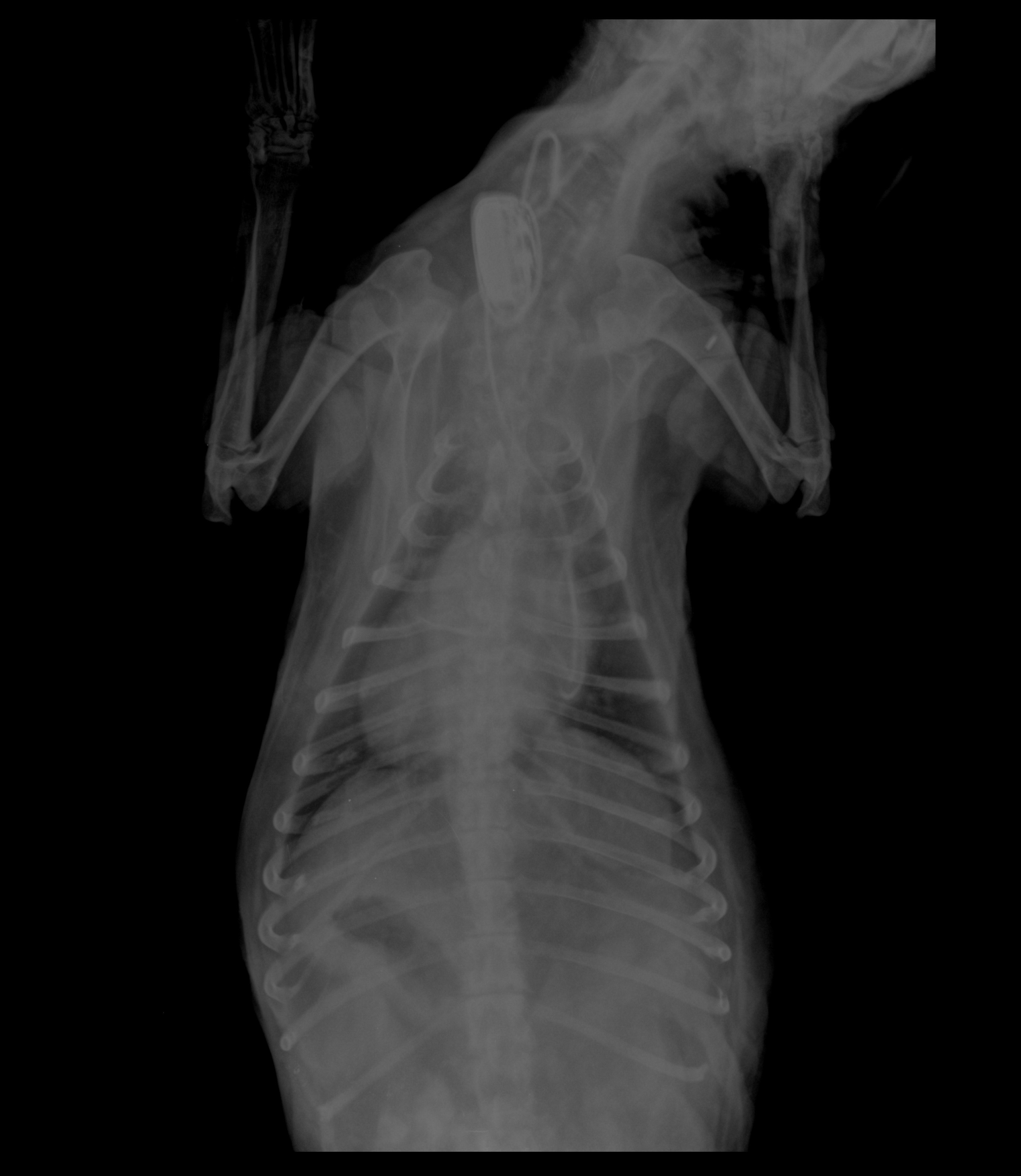 Рис. 4 и 5. Рентгеновские снимки после операции – расположение электрода в полости правого желудочка.