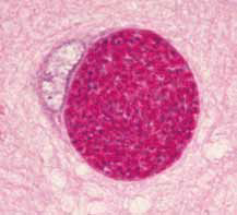 Тканевая циста в головном мозге кошки(periodic acid – Schiff stain, × 400) [17]