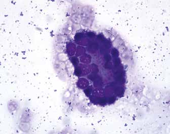 Метастаз рака железистого строения (рак желудка), асцитическая жидкость, азур-эозин, ×1000