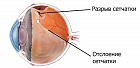 Отслоение сетчатки глаза у кошек симптомы