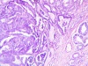     ? - , ,  / What do we know about adenocarcinomas? Clinical and morphological features, localization, histogenesis