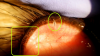     /Ectopic eyelashes in veterinary ophthalmology